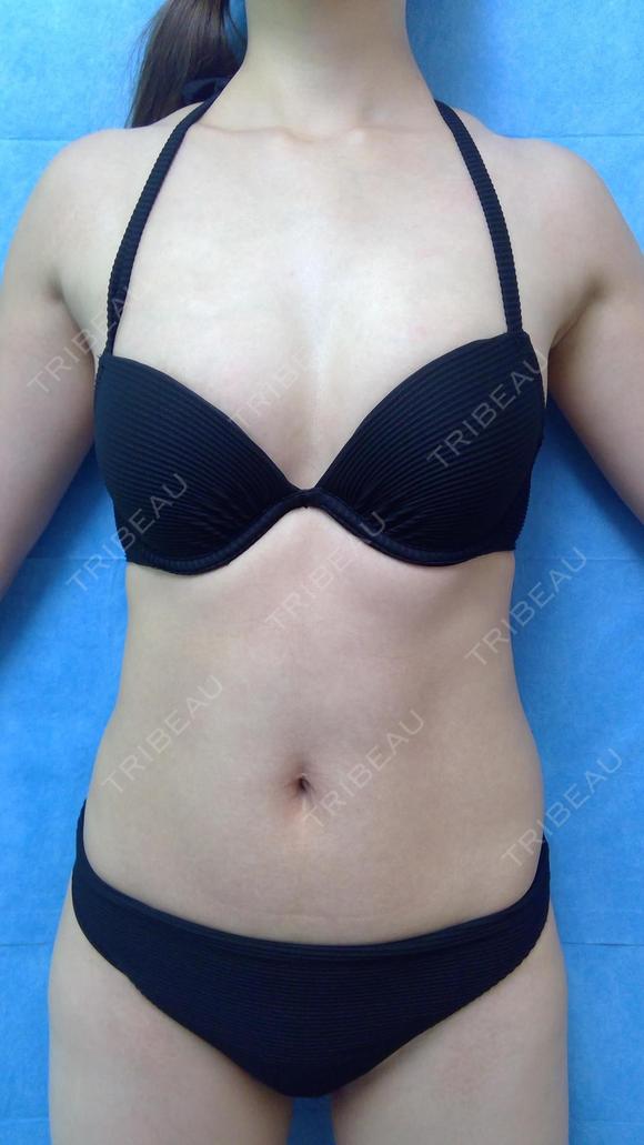 脂肪吸引　腹全周　大腿内側　膝内側 before画像 メイン用