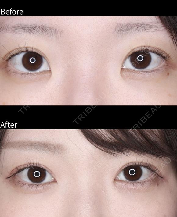 目頭切開 after画像 メイン用