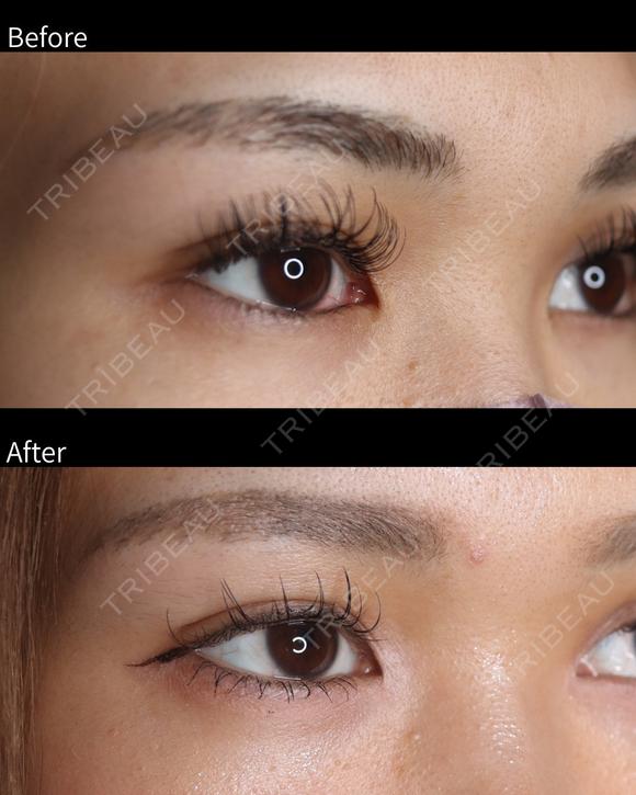 目頭切開・目尻切開 before画像 メイン用