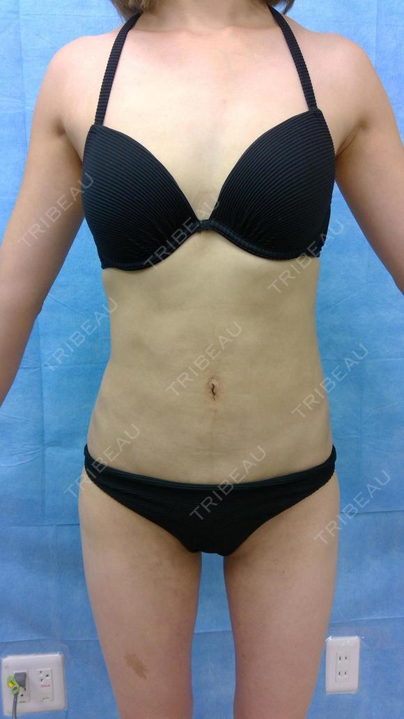 脂肪吸引　腹全周　大腿内側　膝内側 after画像 メイン用