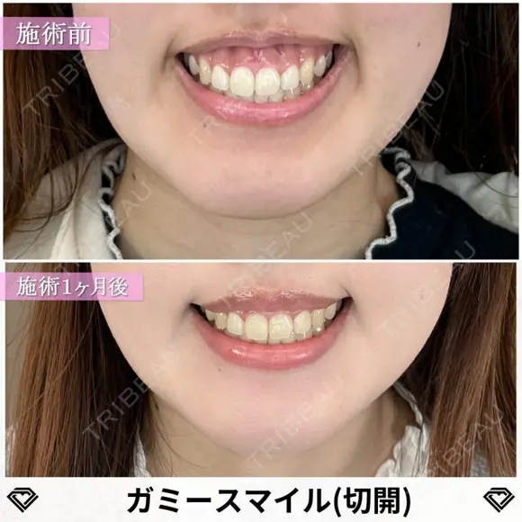 ガミースマイル治療（ボトックス・切開） 30日後 メイン用