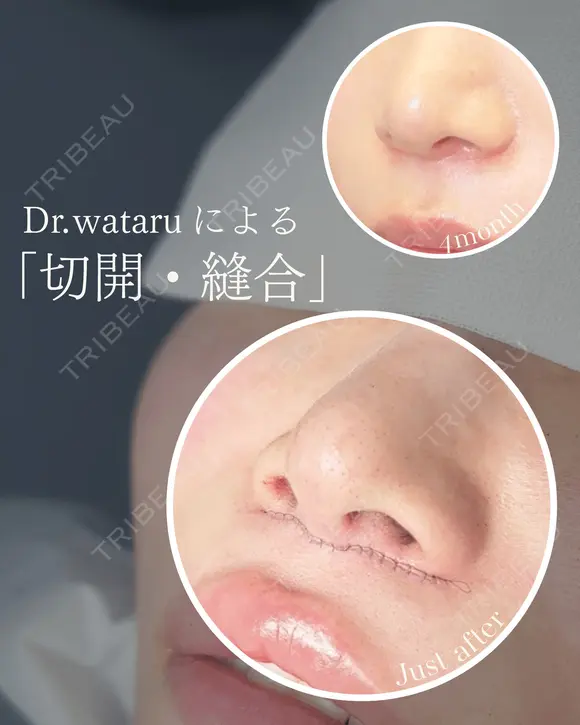 切開施術（人中短縮・眉下切開・） after画像 メイン用