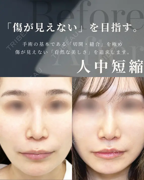 切開施術（人中短縮・眉下切開・） before画像 メイン用