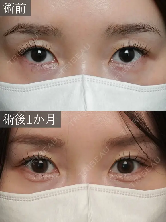二重埋没　裏シークレットダブルループ before画像 メイン用