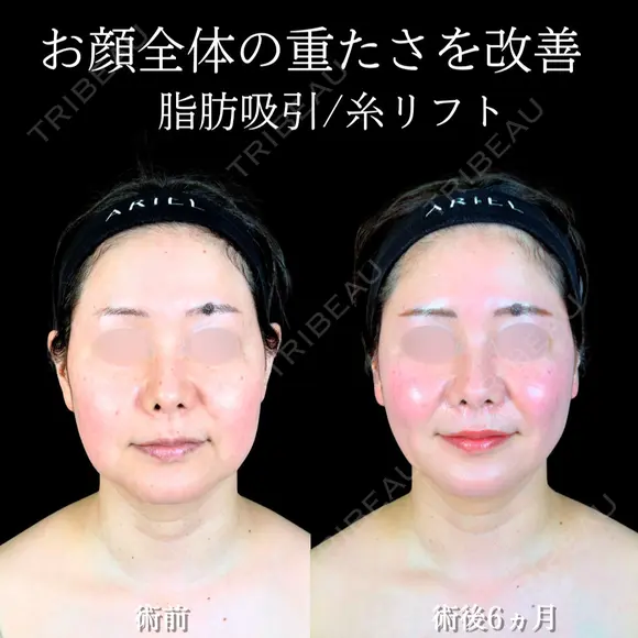 頬・あご下脂肪吸引 /糸リフト/バッカルファット/エラボトックス 180日後 メイン用