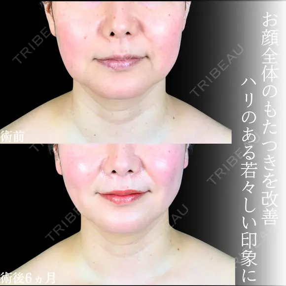 頬・あご下脂肪吸引 /糸リフト/バッカルファット/エラボトックス before画像 メイン用