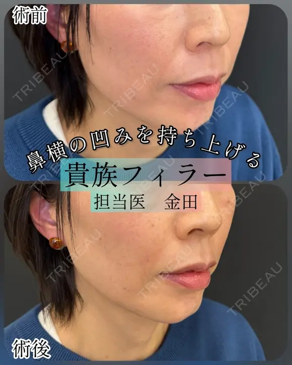 貴族フィラー（小鼻横の凹みに対するヒアルロン酸注入） before画像 メイン用