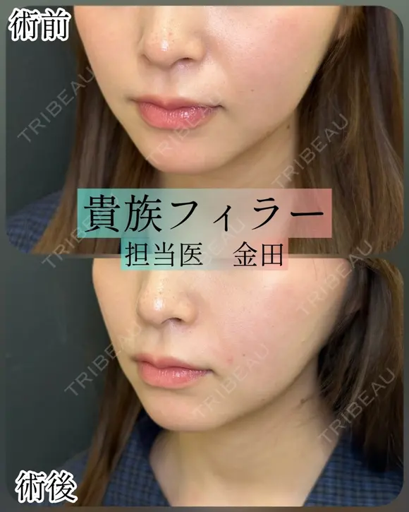 貴族フィラー（小鼻横の凹みに対するヒアルロン酸注入） after画像 メイン用