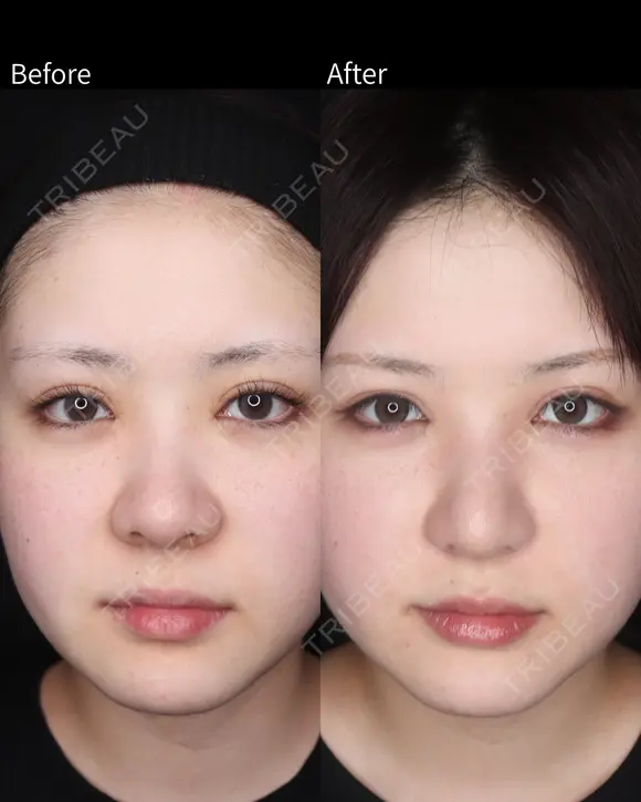 鼻尖形成・耳珠軟骨移植・小鼻縮小 before画像 メイン用