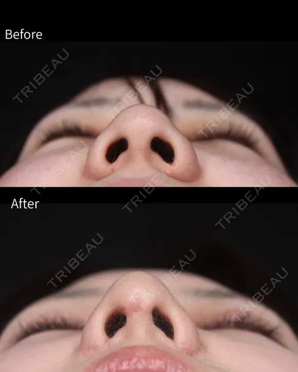 鼻尖形成・耳珠軟骨移植・小鼻縮小 after画像 メイン用