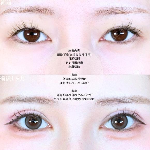 眼瞼下垂(たるみ取り併用)/目尻切開/タレ目形成術/皮膚切除 before画像 メイン用