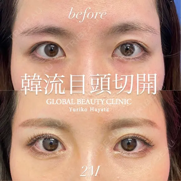 韓流目頭切開 after画像 メイン用