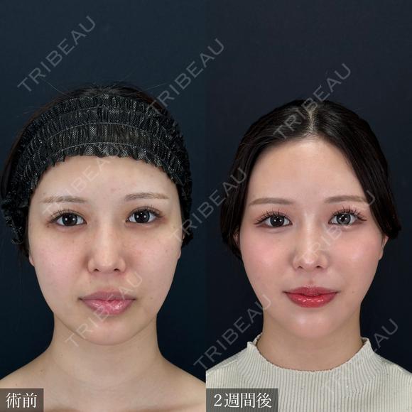 小顔脂肪吸引 before画像 メイン用