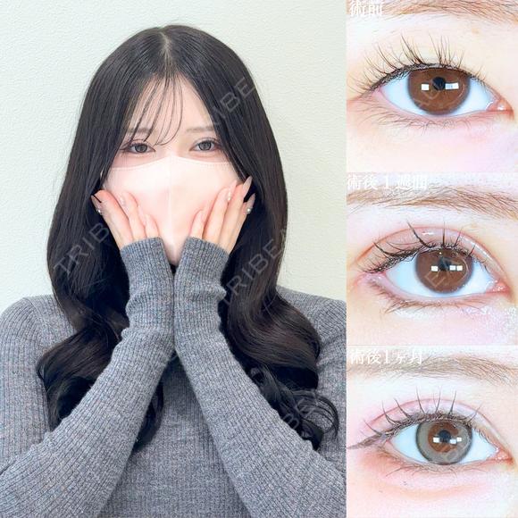 眼瞼下垂(たるみ取り併用)/目尻切開/タレ目形成術/皮膚切除 30日後 メイン用