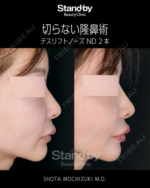 切らない隆鼻術：テスリフトノーズND before画像 メイン用