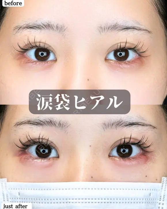 涙袋ヒアルロン酸 after画像 メイン用