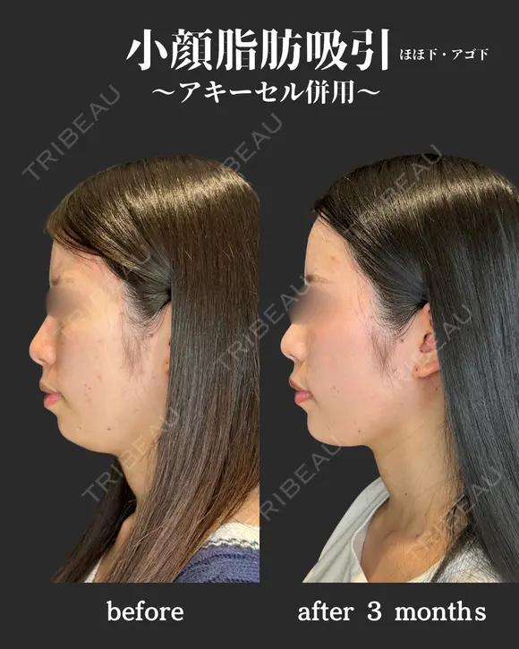 小顔脂肪吸引　アキーセル併用 before画像 メイン用