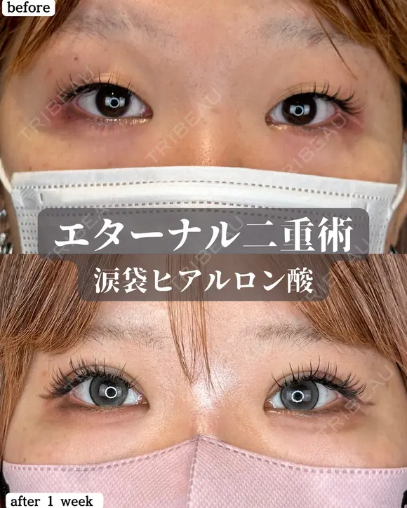 エターナル二重術・涙袋ヒアルロン酸 before画像 メイン用