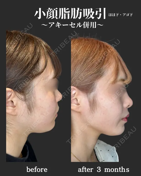 小顔脂肪吸引　アキーセル併用 after画像 メイン用
