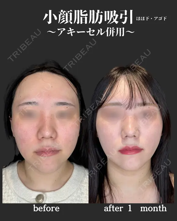小顔脂肪吸引　アキーセル併用 before画像 メイン用