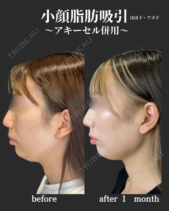 小顔脂肪吸引　アキーセル併用 before画像 メイン用