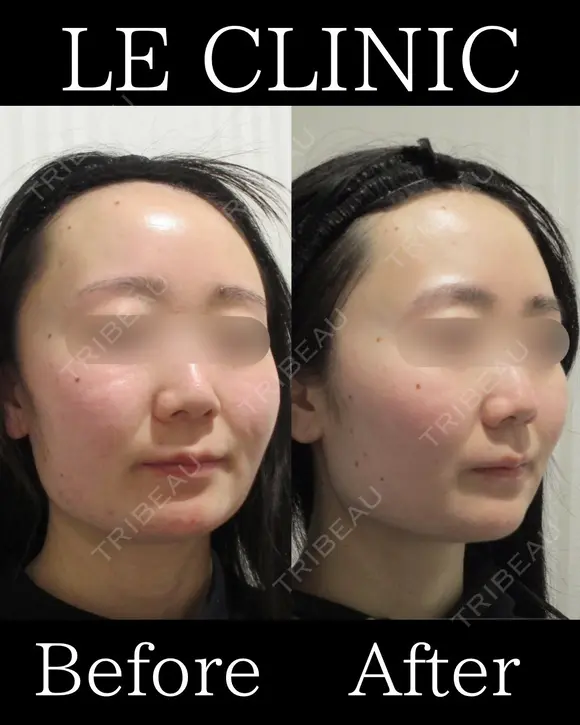 ピコトーニング+白玉点滴 before画像 メイン用