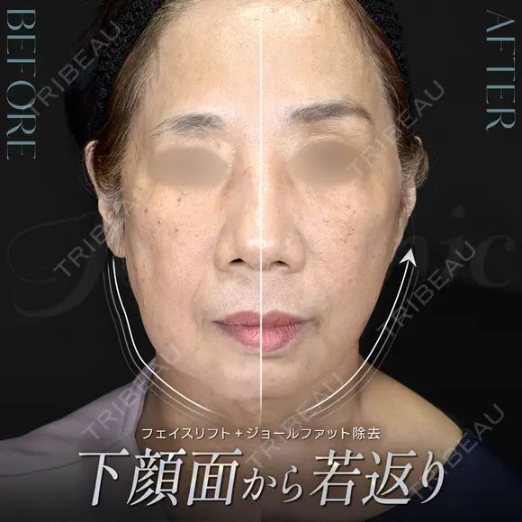 フェイスリフト＋ジョールファット除去 before画像 メイン用