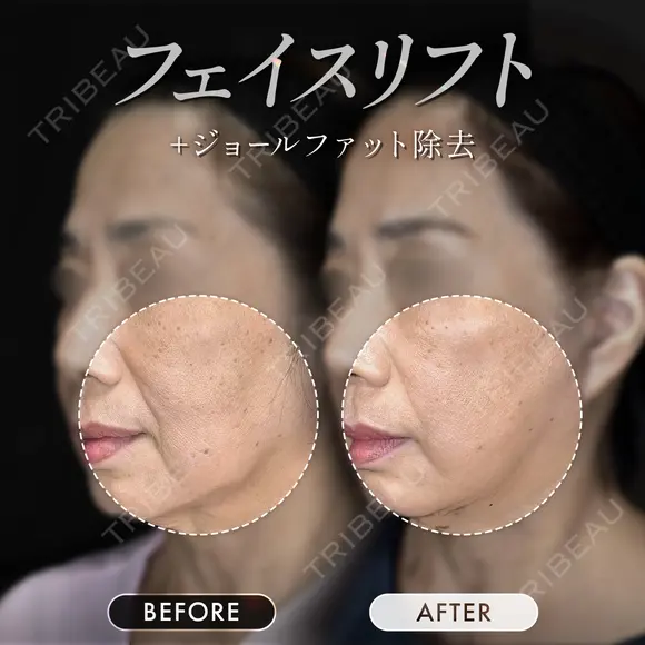 フェイスリフト＋ジョールファット除去 90日後 メイン用
