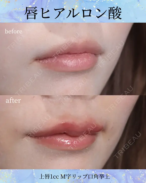 ヒアルロン酸 (M字)上唇1cc before画像 メイン用