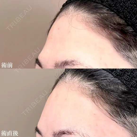 おでこ・こめかみのデザイン注射（ヒアルロン酸） before画像 メイン用