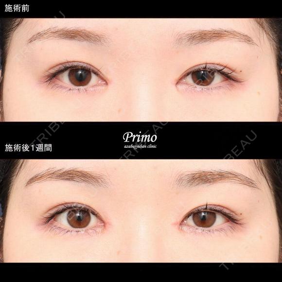 BJ 蒙古襞形成術（目頭切開修正） before画像 メイン用