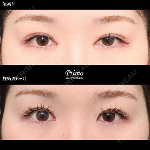 BJ 蒙古襞形成術（目頭切開修正） 180日後 メイン用
