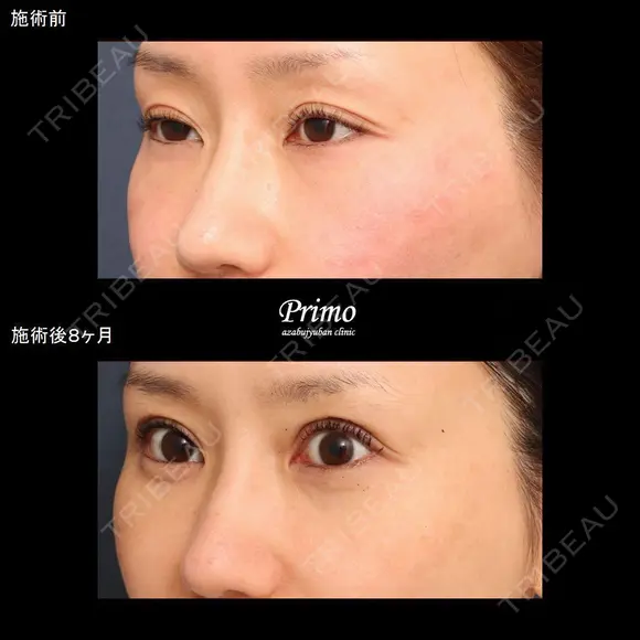  GX 眼瞼下垂手術＋下眼瞼切開術（裏ハムラ法）（術後2ヶ月後右目眼瞼下垂修正術＋左目二重修正術） before画像 メイン用