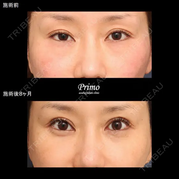  GX 眼瞼下垂手術＋下眼瞼切開術（裏ハムラ法）（術後2ヶ月後右目眼瞼下垂修正術＋左目二重修正術） 240日後 メイン用