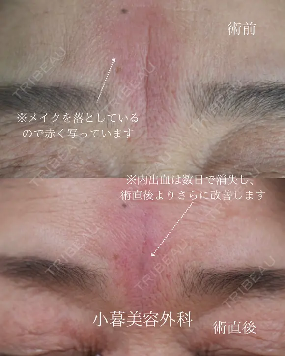 眉間ヒアルロン酸 before画像 メイン用