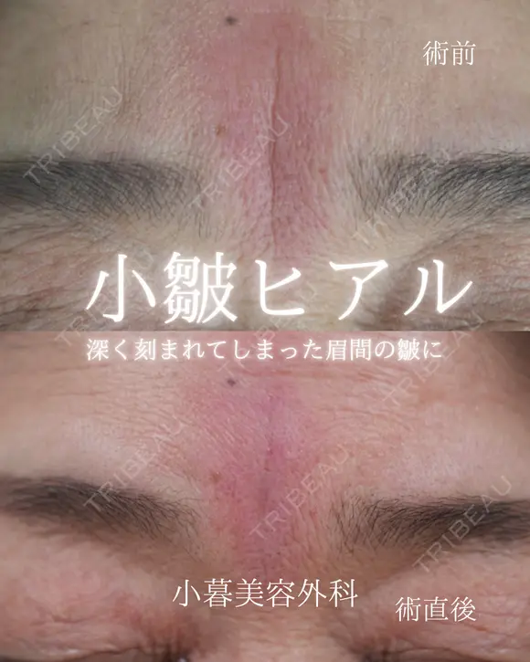眉間ヒアルロン酸 0日後 メイン用
