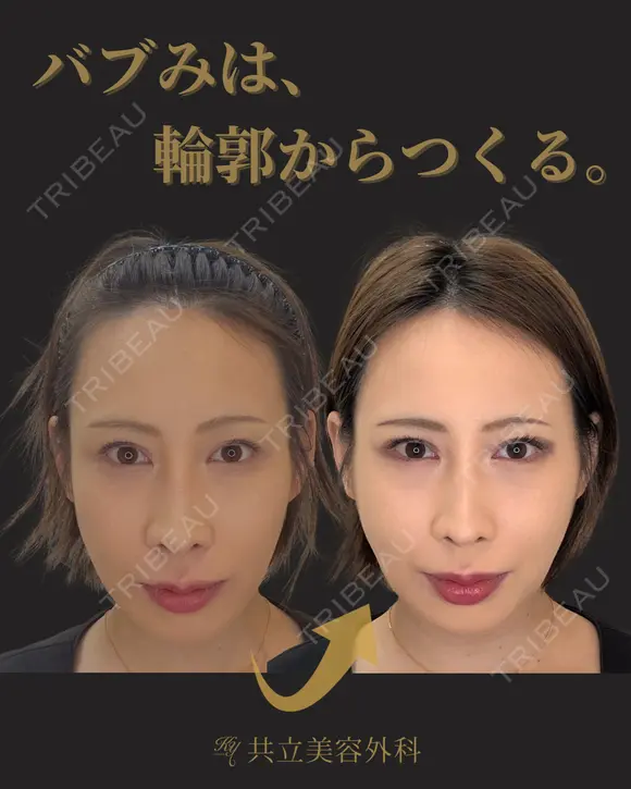糸リフト 7日後 メイン用