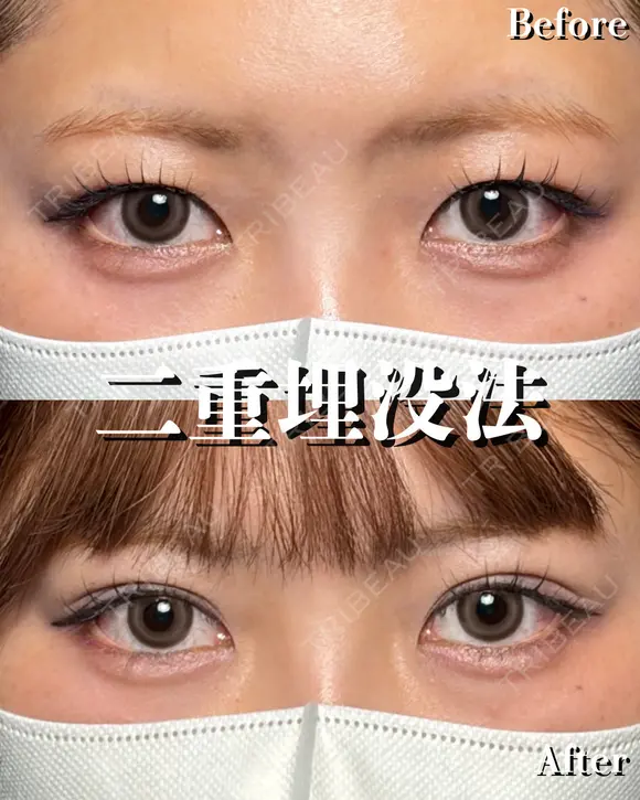 RÉシークレットダブル before画像 メイン用