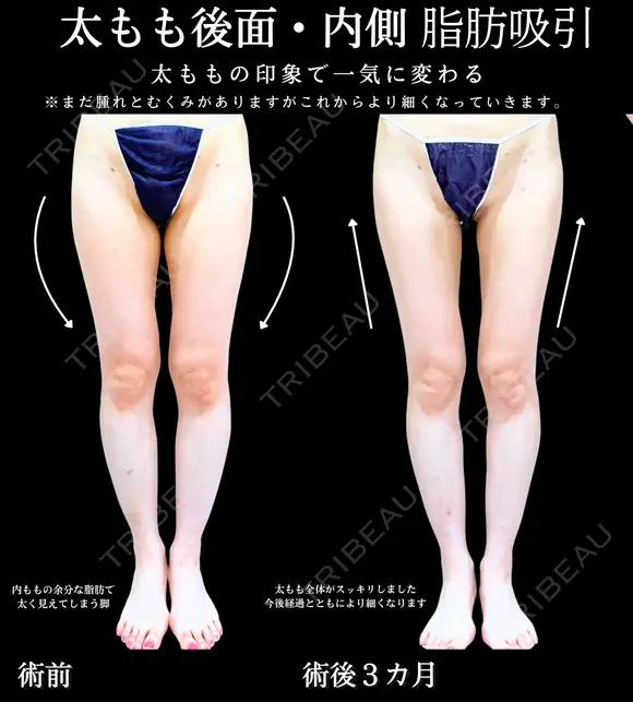 後方・内側太もも脂肪吸引 before画像 メイン用