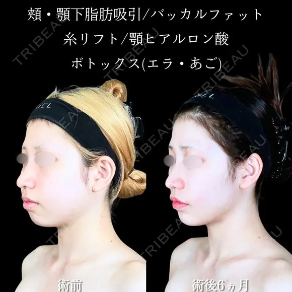 頬・顎下脂肪吸引/バッカルファット/ジョールファット/エラボトックス/糸リフト/顎ヒアルロン酸・ボトックス before画像 メイン用