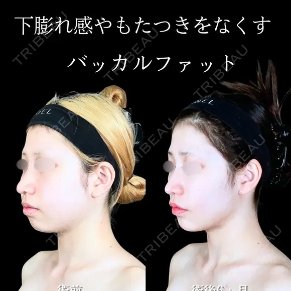 頬・顎下脂肪吸引/バッカルファット/ジョールファット/エラボトックス/糸リフト/顎ヒアルロン酸・ボトックス 180日後 メイン用