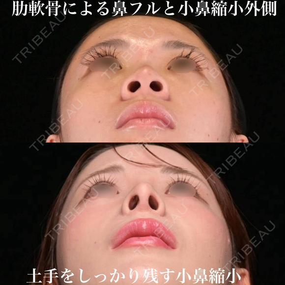 術後1年 肋軟骨よる鼻中隔延長、耳介軟骨移植、鼻尖形成、鼻孔縁下降、小鼻縮小外側、ソフトプロテーゼ 額、こめかみ、目の下、ゴルゴ脂肪吸引 365日後 メイン用