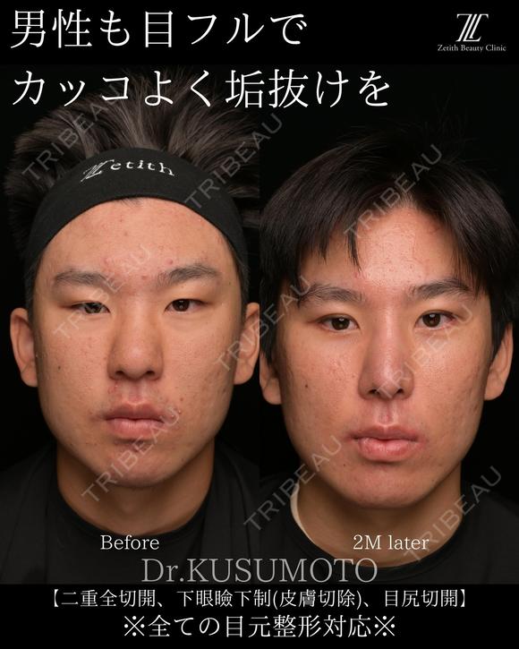 【術式：二重全切開、タレ目手術、目尻切開】 の組み合わせ目フルの症例です。 60日後 メイン用
