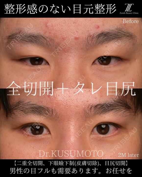 【術式：二重全切開、タレ目手術、目尻切開】 の組み合わせ目フルの症例です。 60日後 メイン用