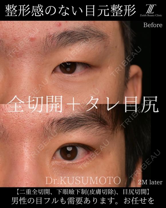 【術式：二重全切開、タレ目手術、目尻切開】 の組み合わせ目フルの症例です。 60日後 メイン用
