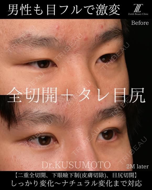 【術式：二重全切開、タレ目手術、目尻切開】 の組み合わせ目フルの症例です。 60日後 メイン用