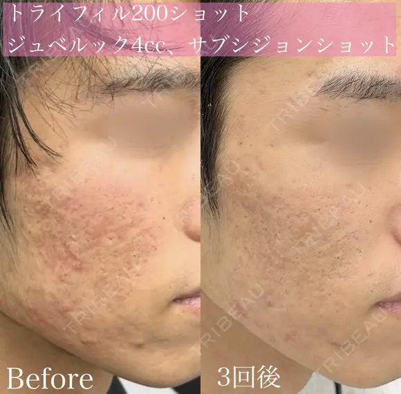 トライフィルプロ　サブシジョンショット付き before画像 メイン用