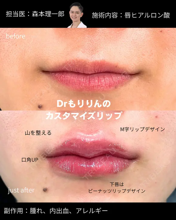 唇のヒアルロン酸💋✨ after画像 メイン用