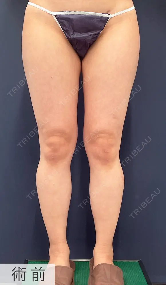 脂肪吸引(太もも・お尻・膝・ふくらはぎ) before画像 メイン用