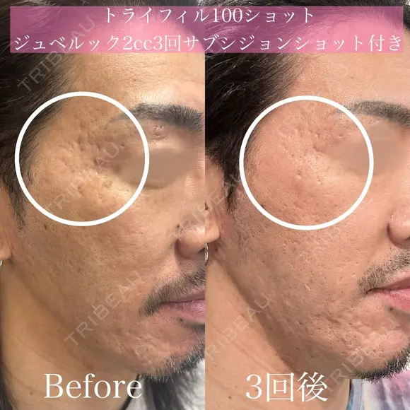 トライフィルプロ100ショット　ジュベルック2㏄　サブシジョンショット付き before画像 メイン用